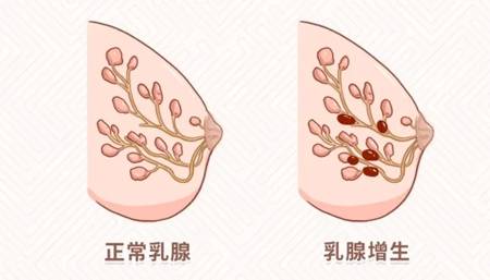 乳腺增生原来是这么回事儿！