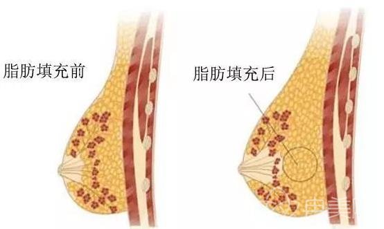 堪比软黄金的自体脂肪，拿来隆胸*果咋样？