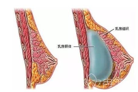 隆胸手术竟然存在这些你不知道的危害！