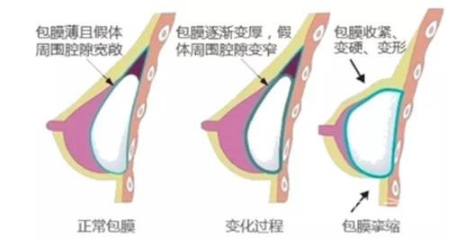 隆胸手术竟然存在这些你不知道的危害！