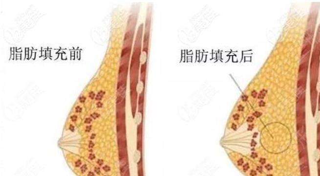 自体脂肪隆胸有没有优势？自体脂肪填充之后太痛怎么办呢?