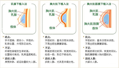 假体隆胸怎么样？果好吗？