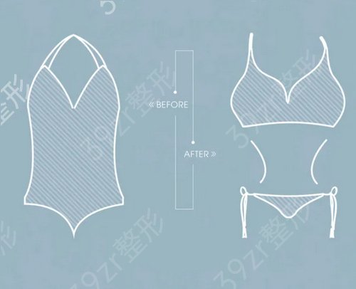 副乳吸脂会有后遗症吗？