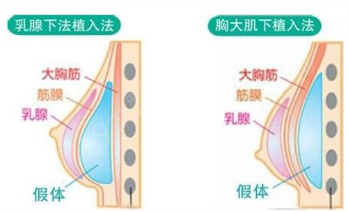娜琦丽假体隆胸让我从此不再是太平公主，感觉手感*的真实