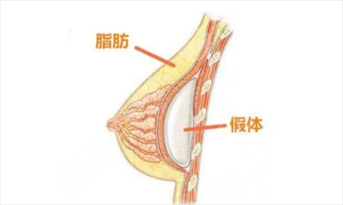 为什么你做假体隆胸会出现失败？当失败了我们怎么办?
