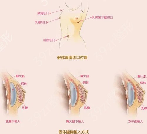 假体隆胸多久和真胸一样软？