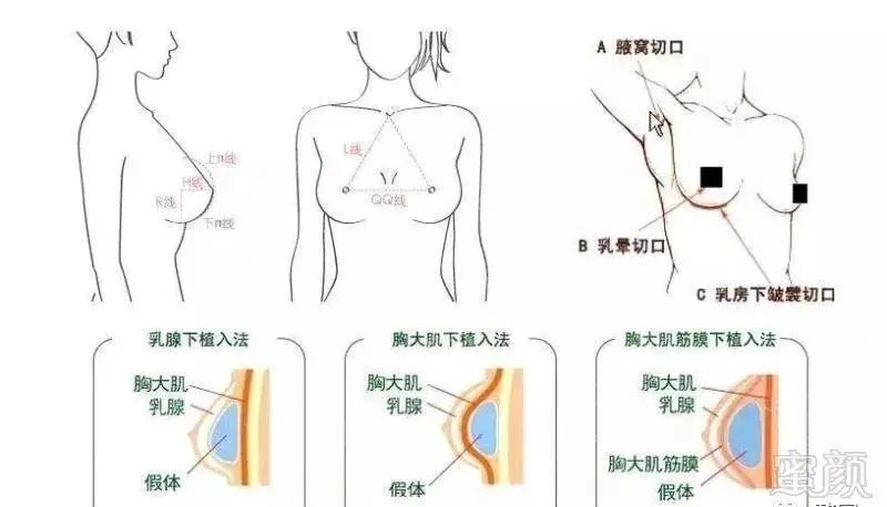 上海抽脂隆胸手术?抽脂丰胸有哪些危害?