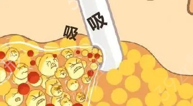 吸脂隆胸手术果怎么样？这些危害劝你提前了解一下
