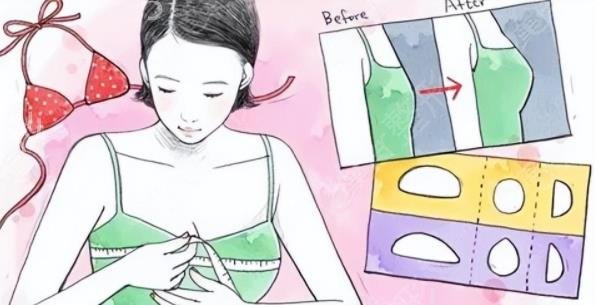自体脂肪隆胸与假体隆胸信息介绍？会影响哺乳吗？