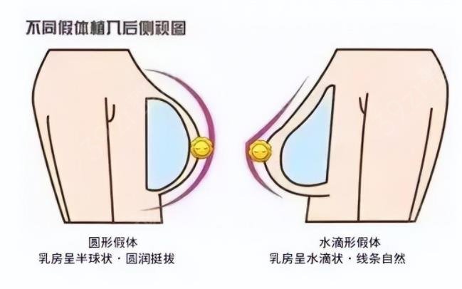 假体隆胸水滴形和圆形信息介绍？