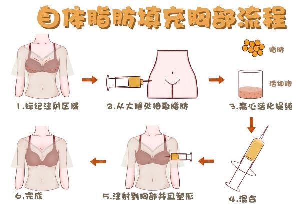 脂肪填充胸部有什么危害？脂肪填充胸部的危险性