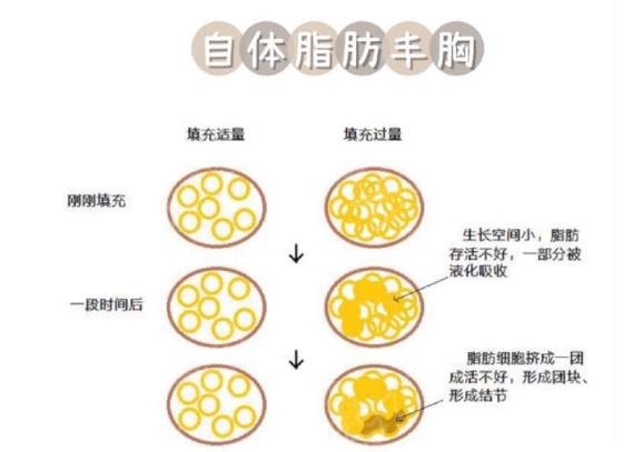 字体脂肪填充胸部多少钱？字体脂肪填充胸部新美容热门做法