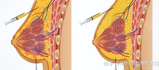 脂肪填充胸部和假体隆胸哪个好？脂肪填充胸部和假体隆胸的优缺点比较