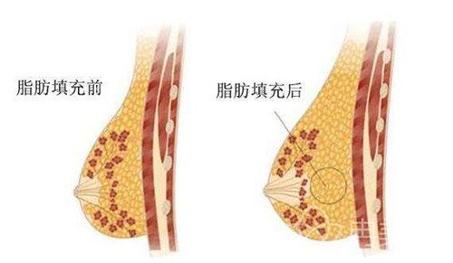 哪些人适合做自体脂肪隆胸？适宜人群列举